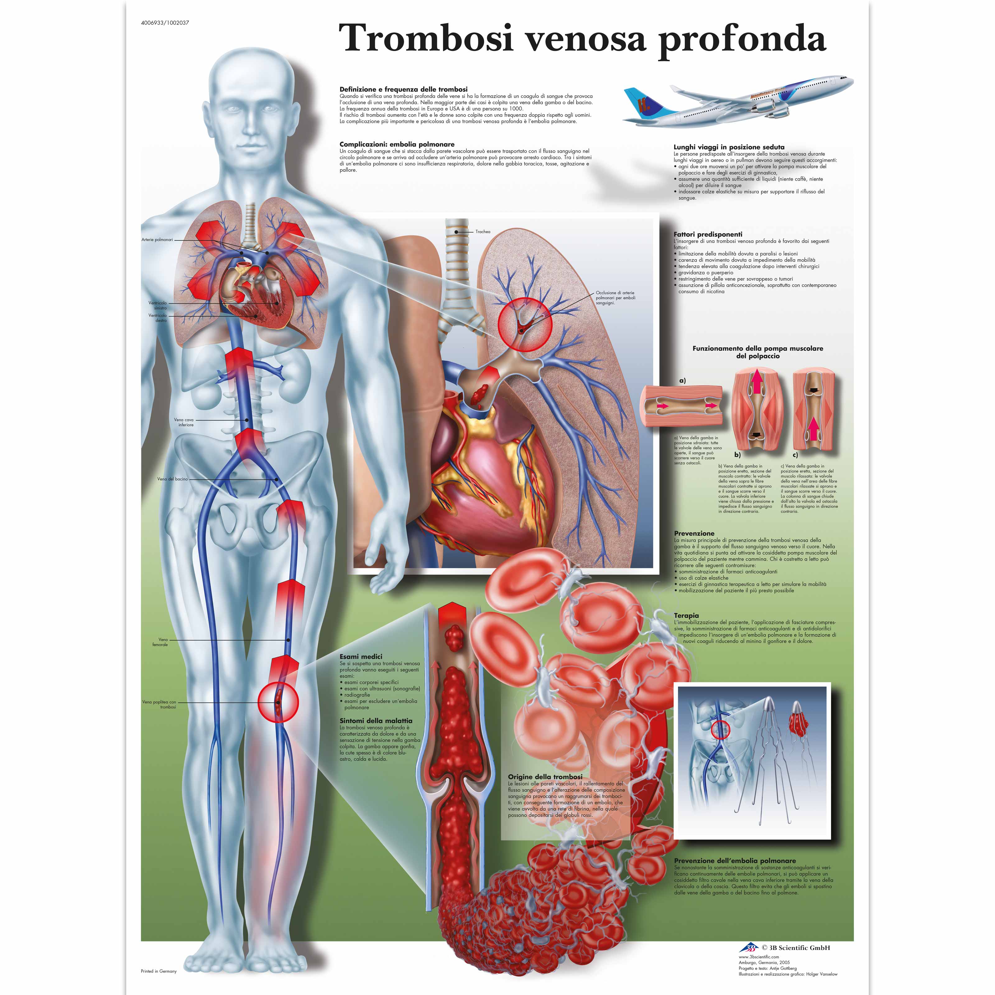 Trombose venosa profonda - 1002037 - VR4368L - système ...